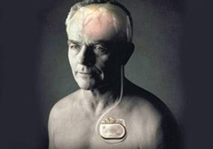 起搏器真的能治好帕金森病嗎？